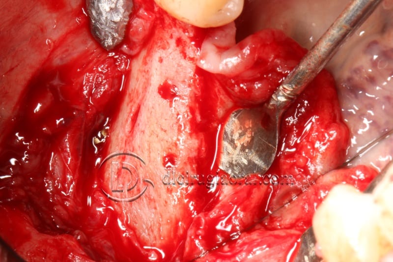 vertical bone augmentation with the Khoury technique