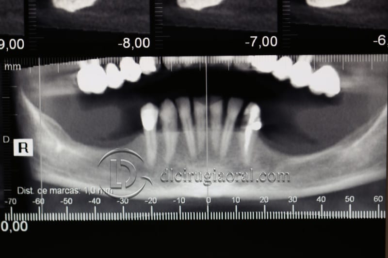 vertical bone augmentation with the Khoury technique