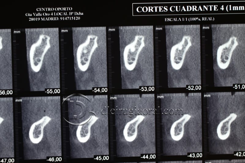 vertical bone augmentation with the Khoury technique