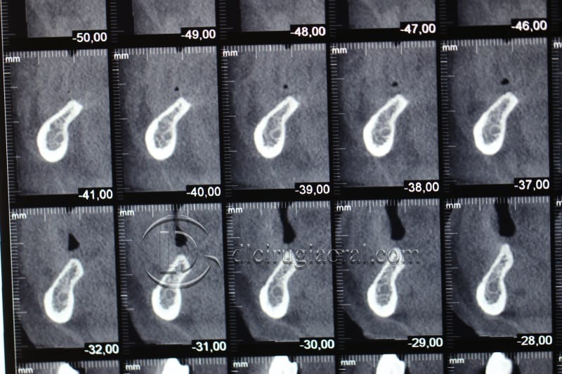 vertical bone augmentation with the Khoury technique