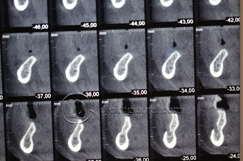 vertical bone augmentation with the Khoury technique