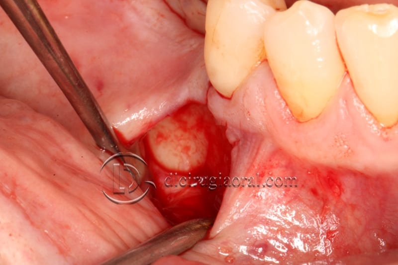 vertical bone augmentation with the Khoury technique