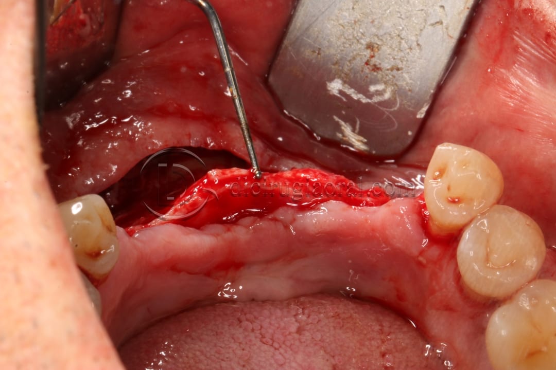 implant placement in augmented area