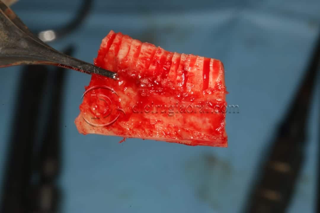 anterior mandible atrophya