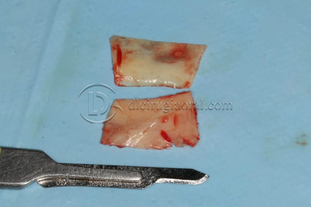 anterior mandible atrophya