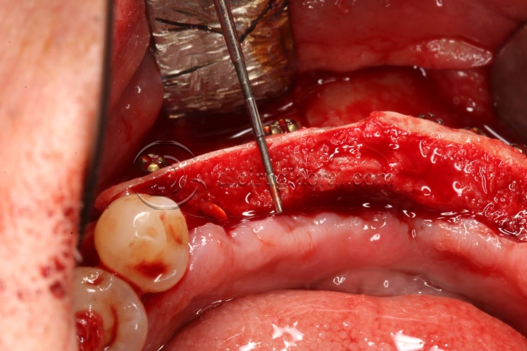 implant placement in augmented area