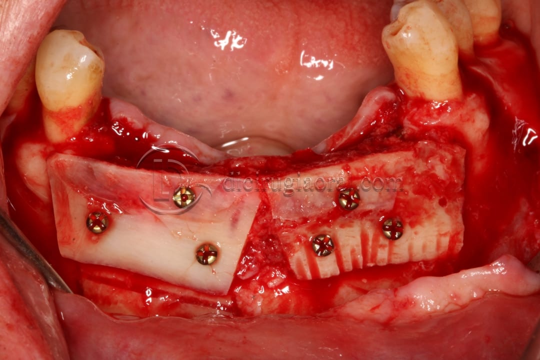 anterior mandible atrophya