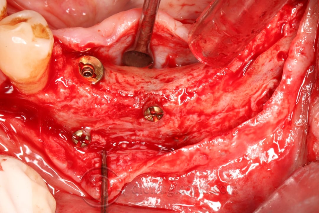 implant placement in augmented area