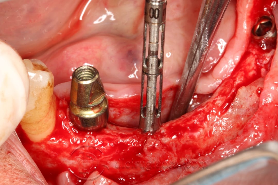 implant placement in augmented area