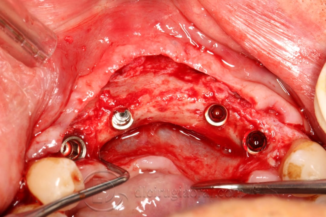 implant placement in augmented area