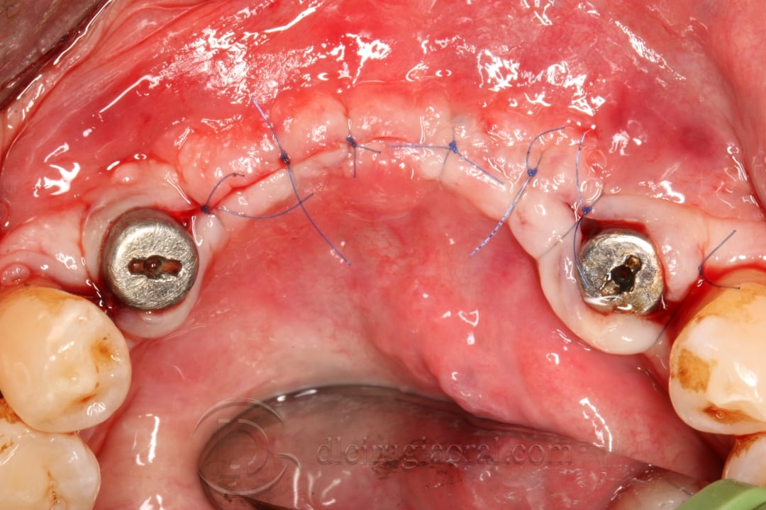 implant placement in augmented area