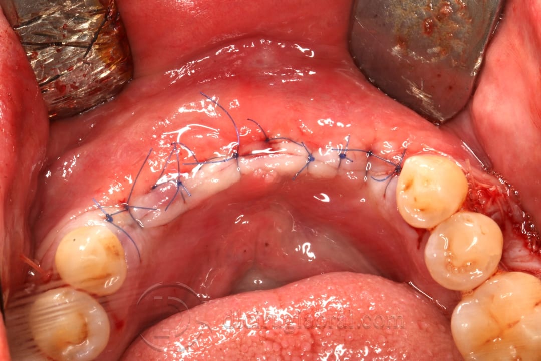 implant placement in augmented area