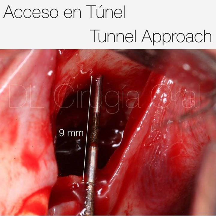 Vertical bone reconstruction in posterior maxilla