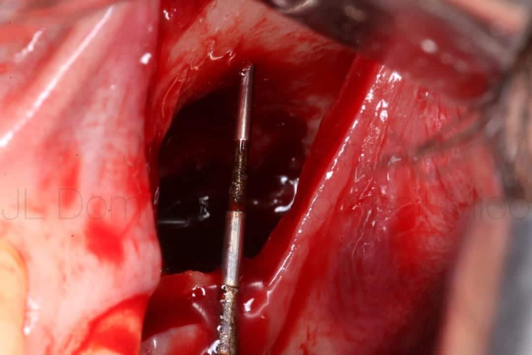 vertical bone reconstruction in posterior maxilla