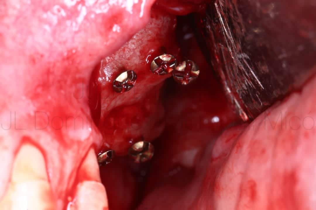 vertical bone reconstruction in posterior maxilla