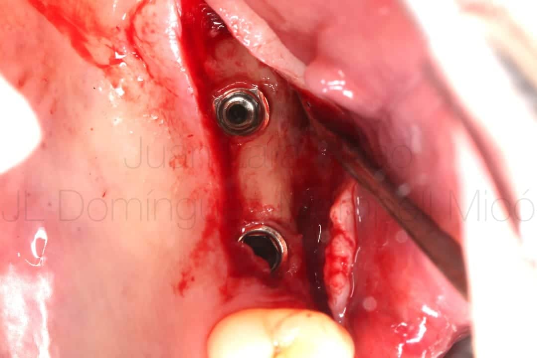 vertical bone reconstruction in posterior maxilla
