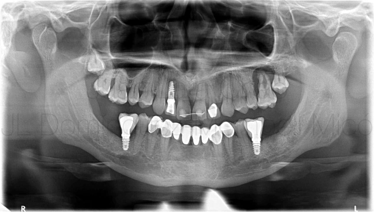 vertical bone reconstruction in posterior maxilla