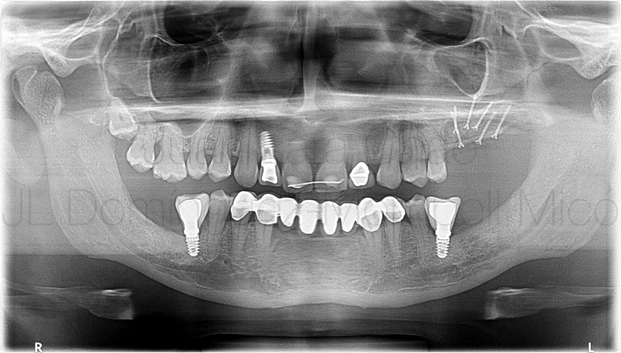 vertical bone reconstruction in posterior maxilla