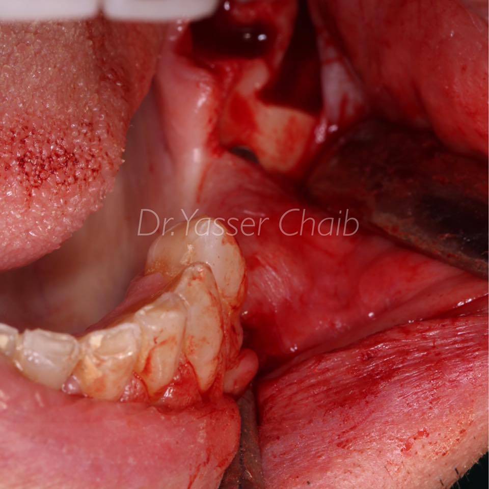 posterior mandible reconstruction