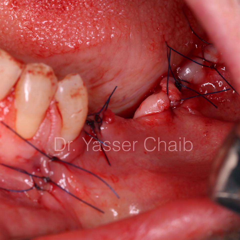 posterior mandible reconstruction