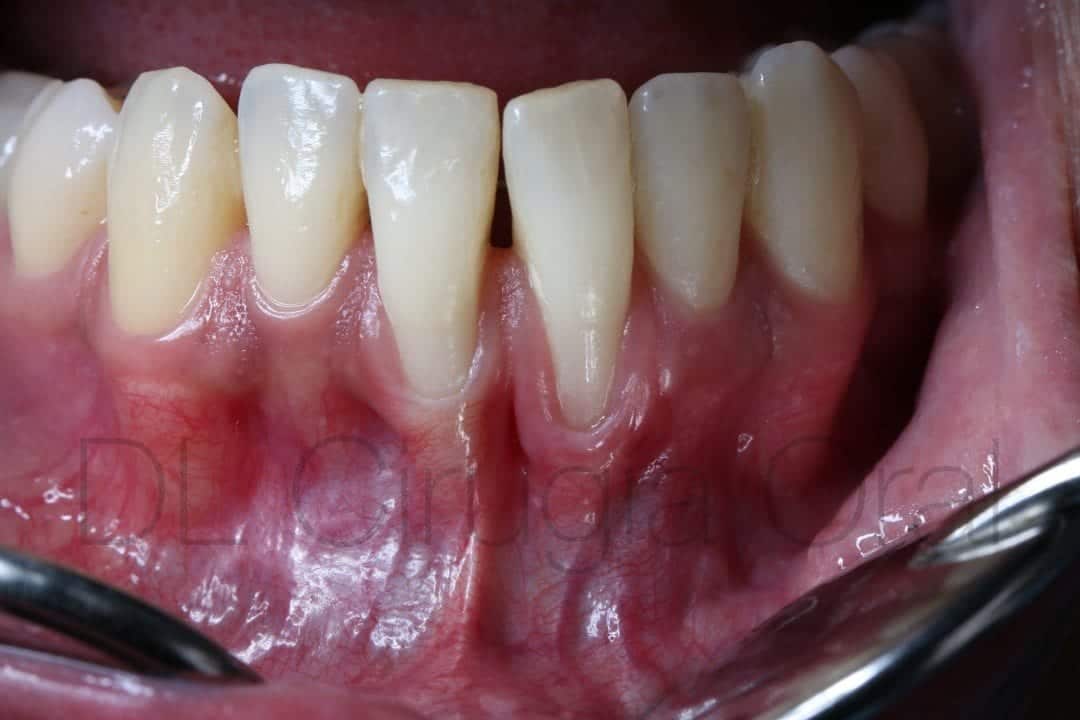 connective tissue graft for recessions