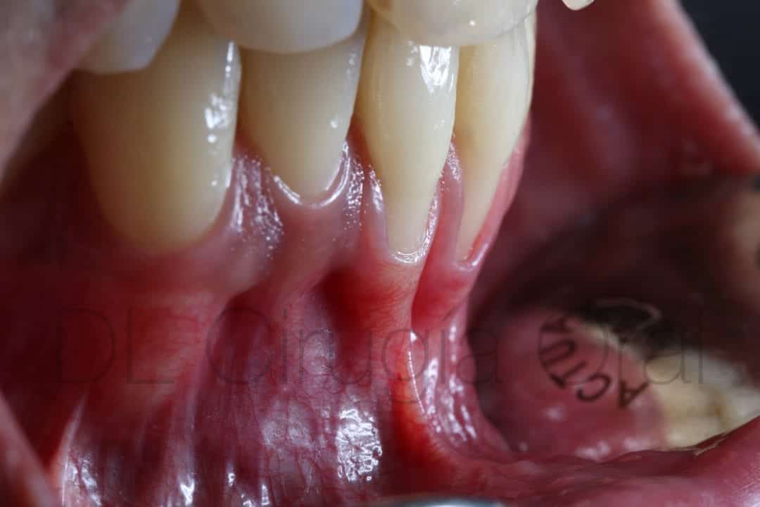Connective tissue graft for recessions in thin biotype