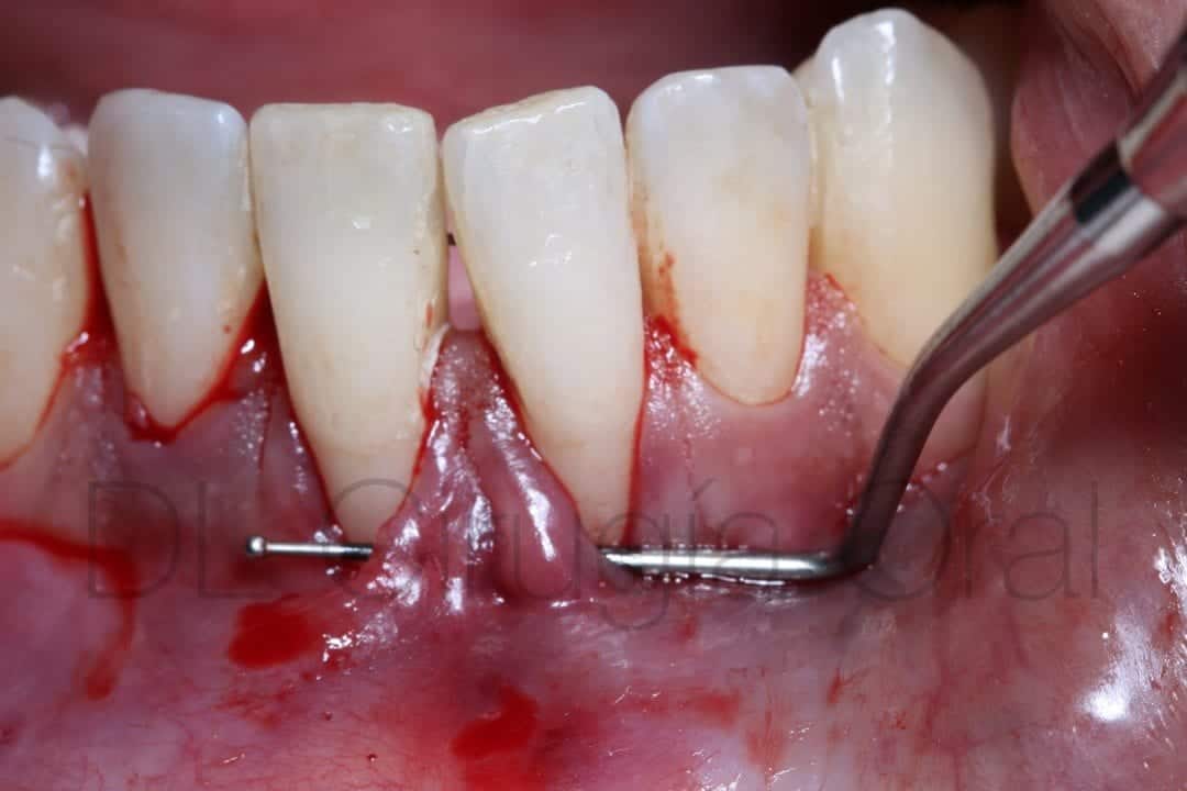 connective tissue graft for recessions