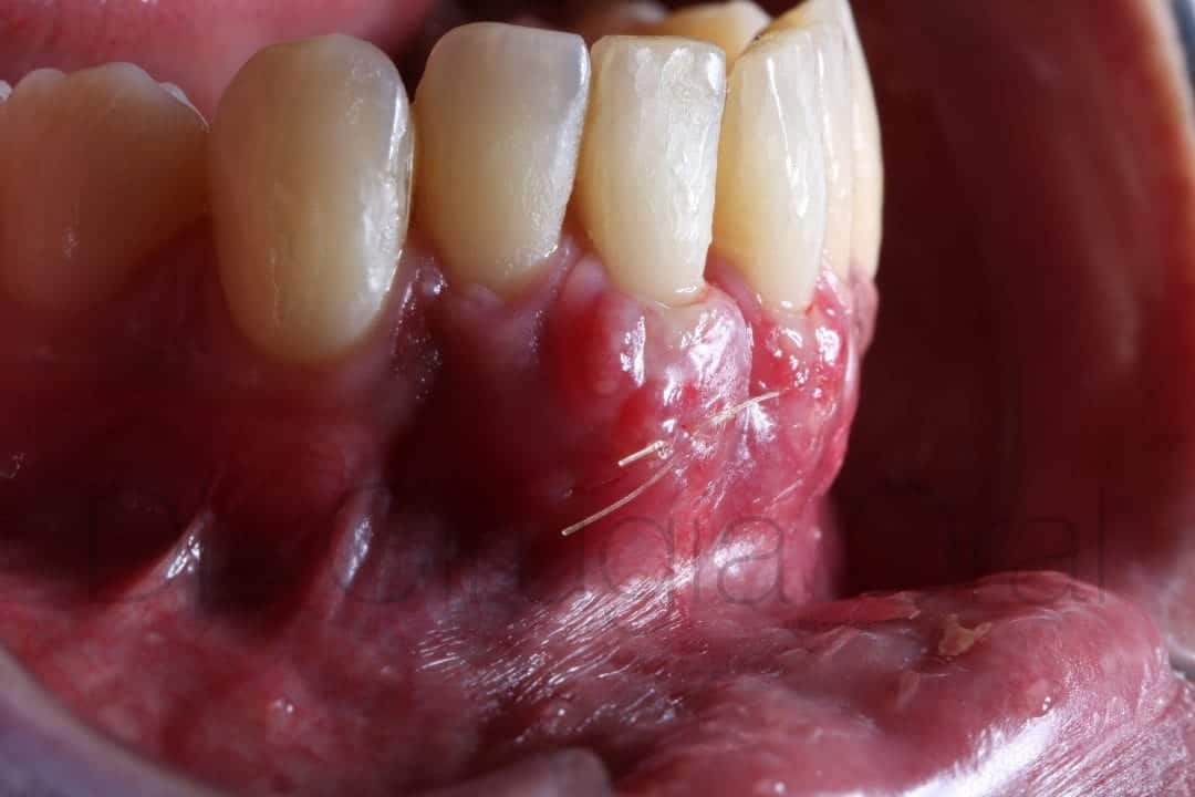 connective tissue graft for recessions