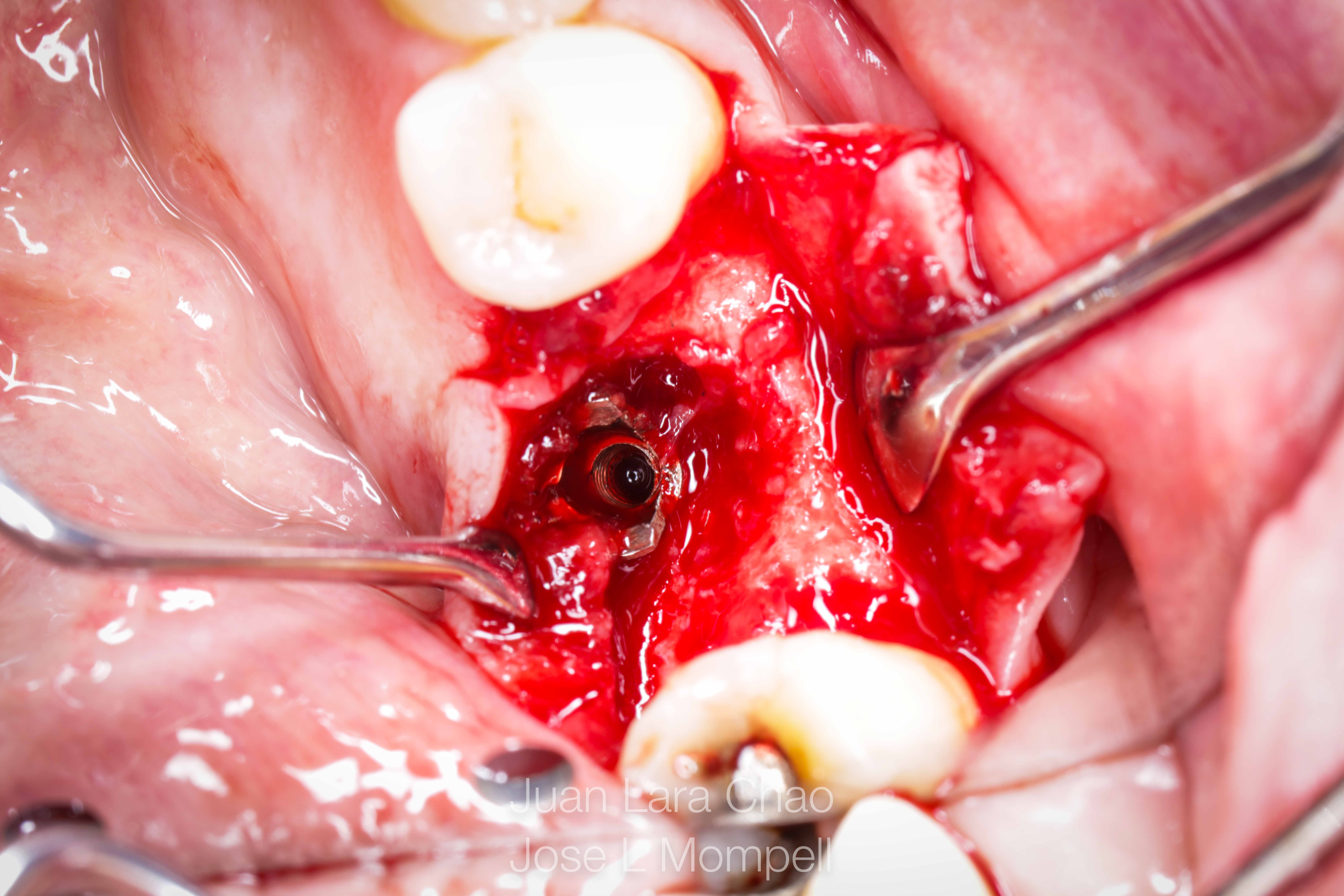 how to remove a fractured implant