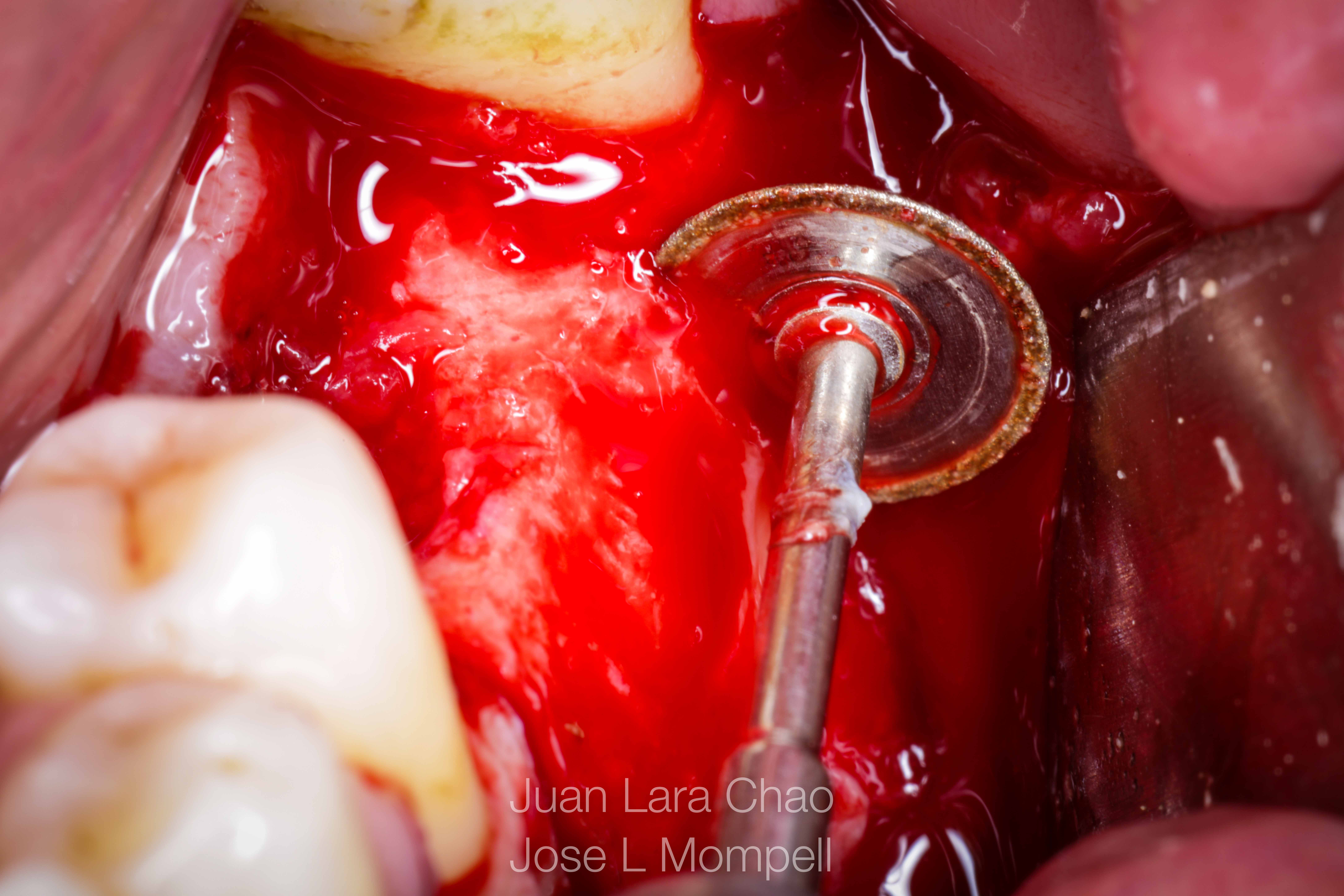 how to remove a fractured implant
