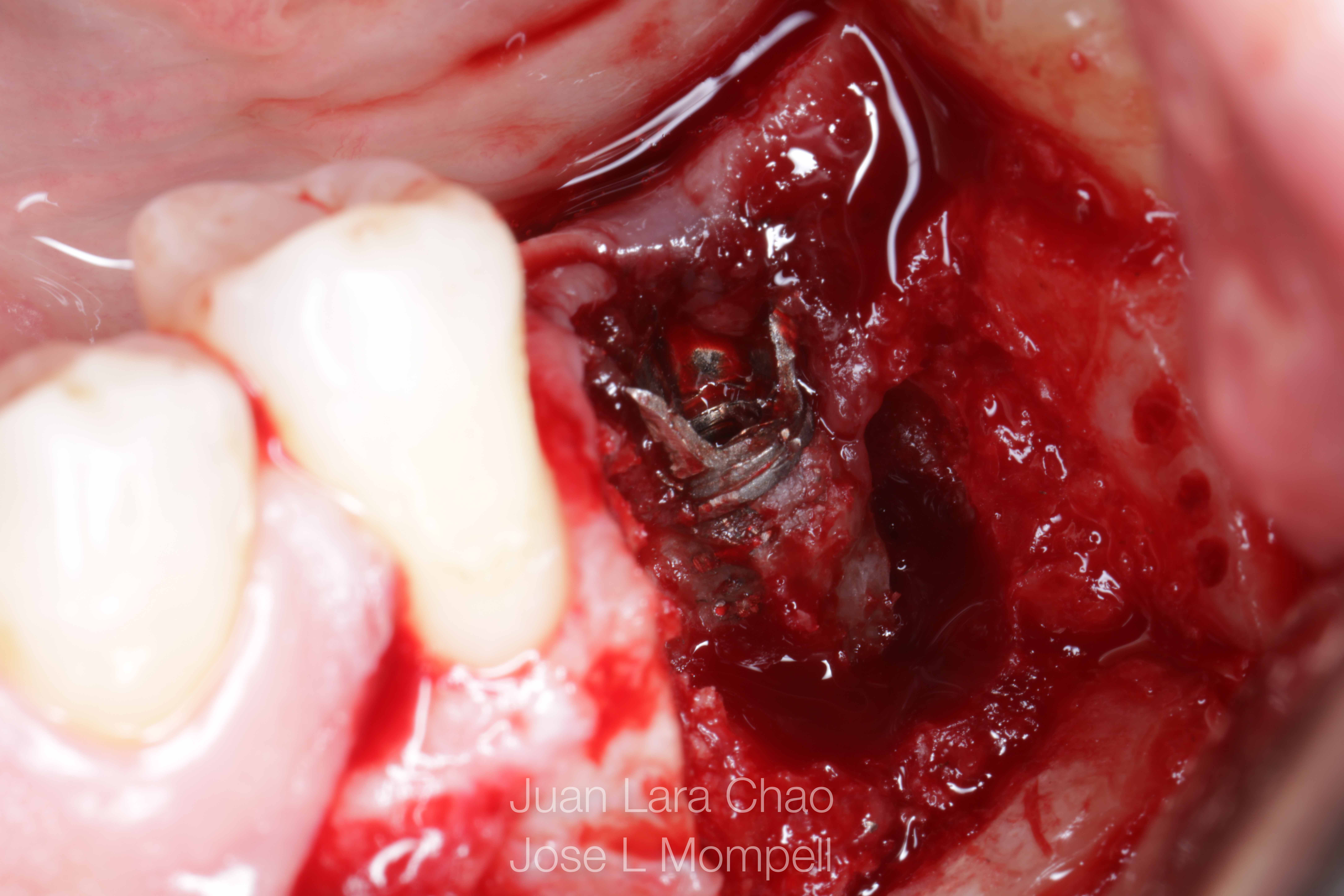 how to remove a fractured implant