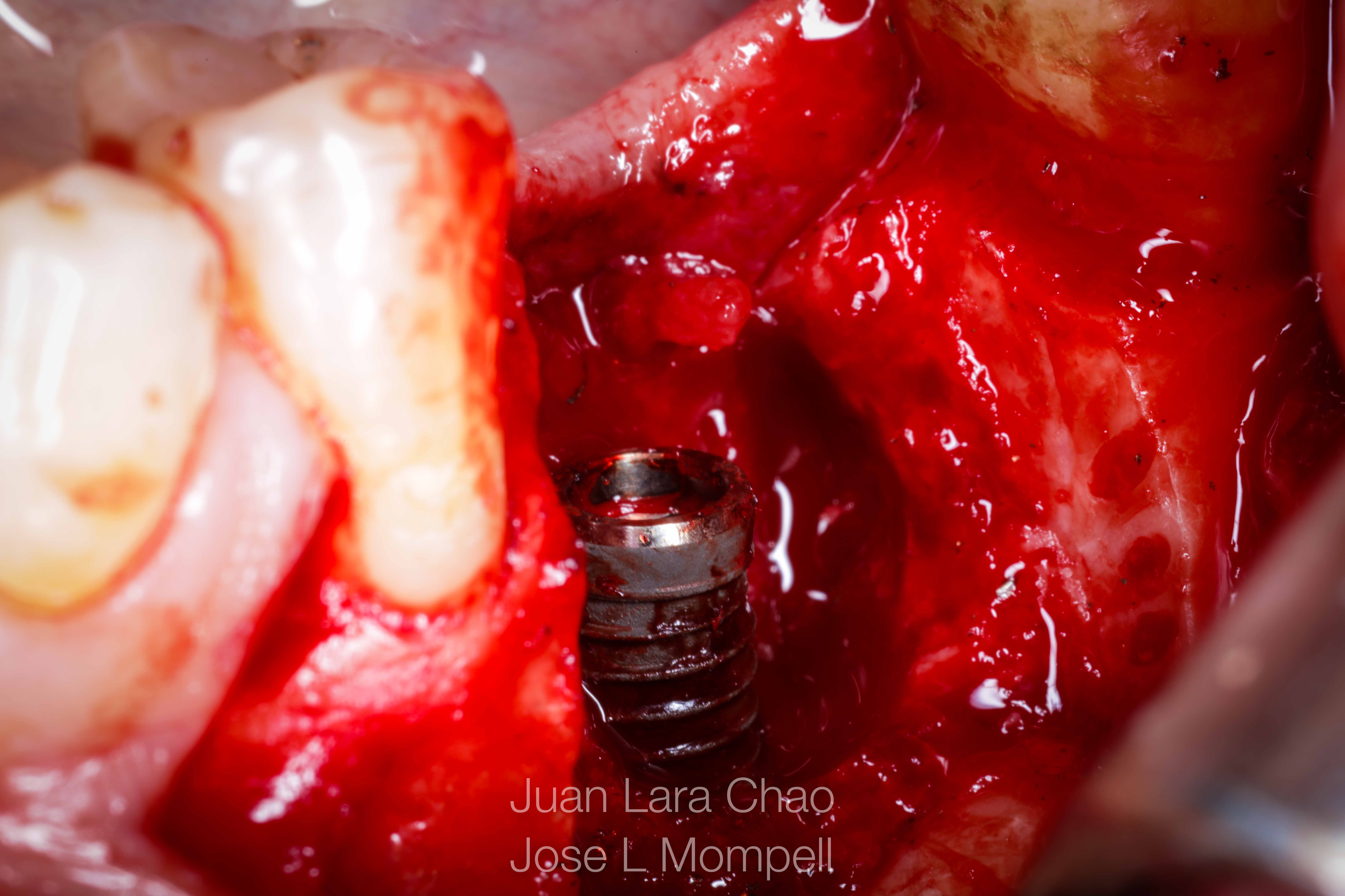 how to remove a fractured implant