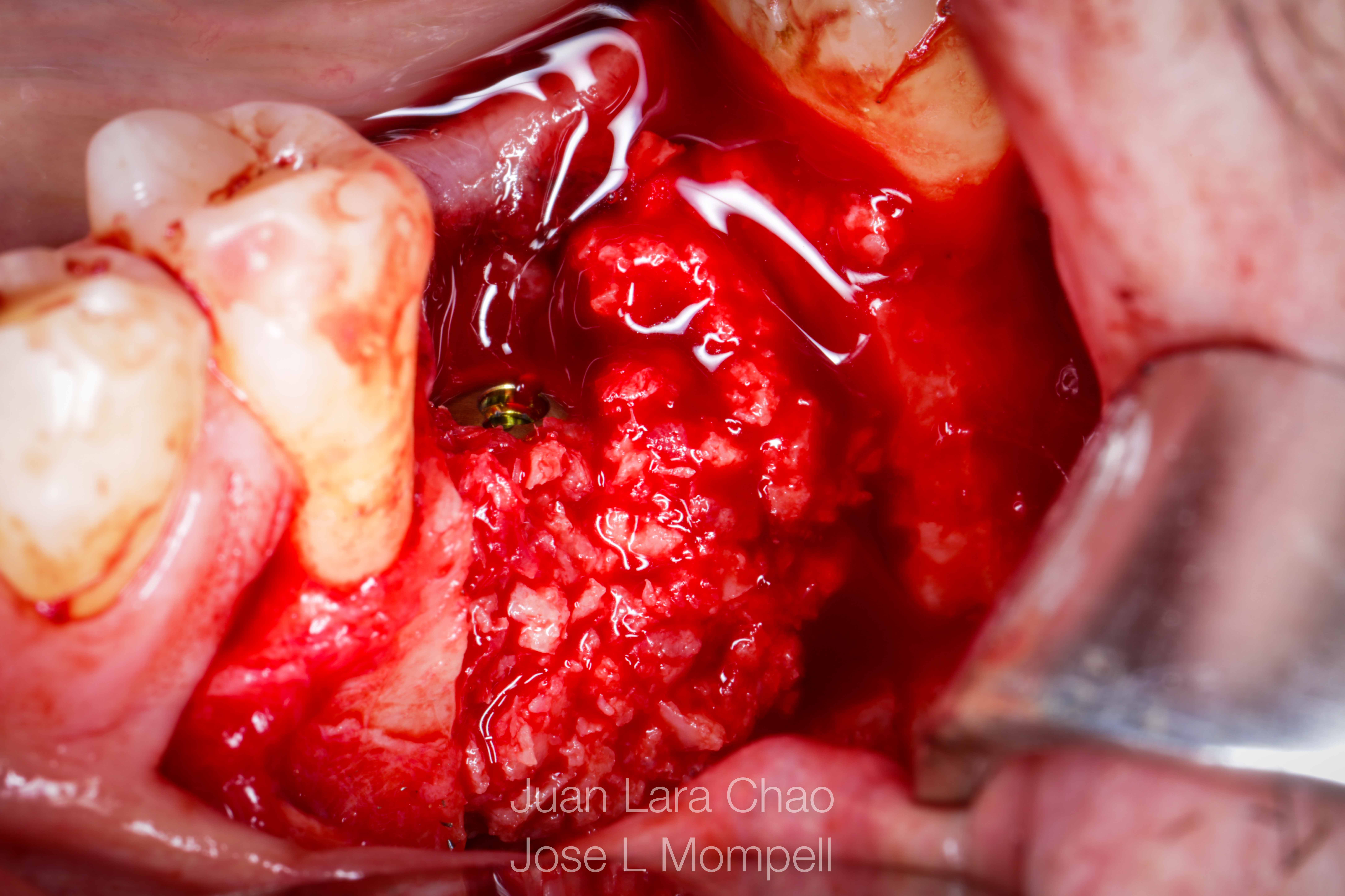 how to remove a fractured implant