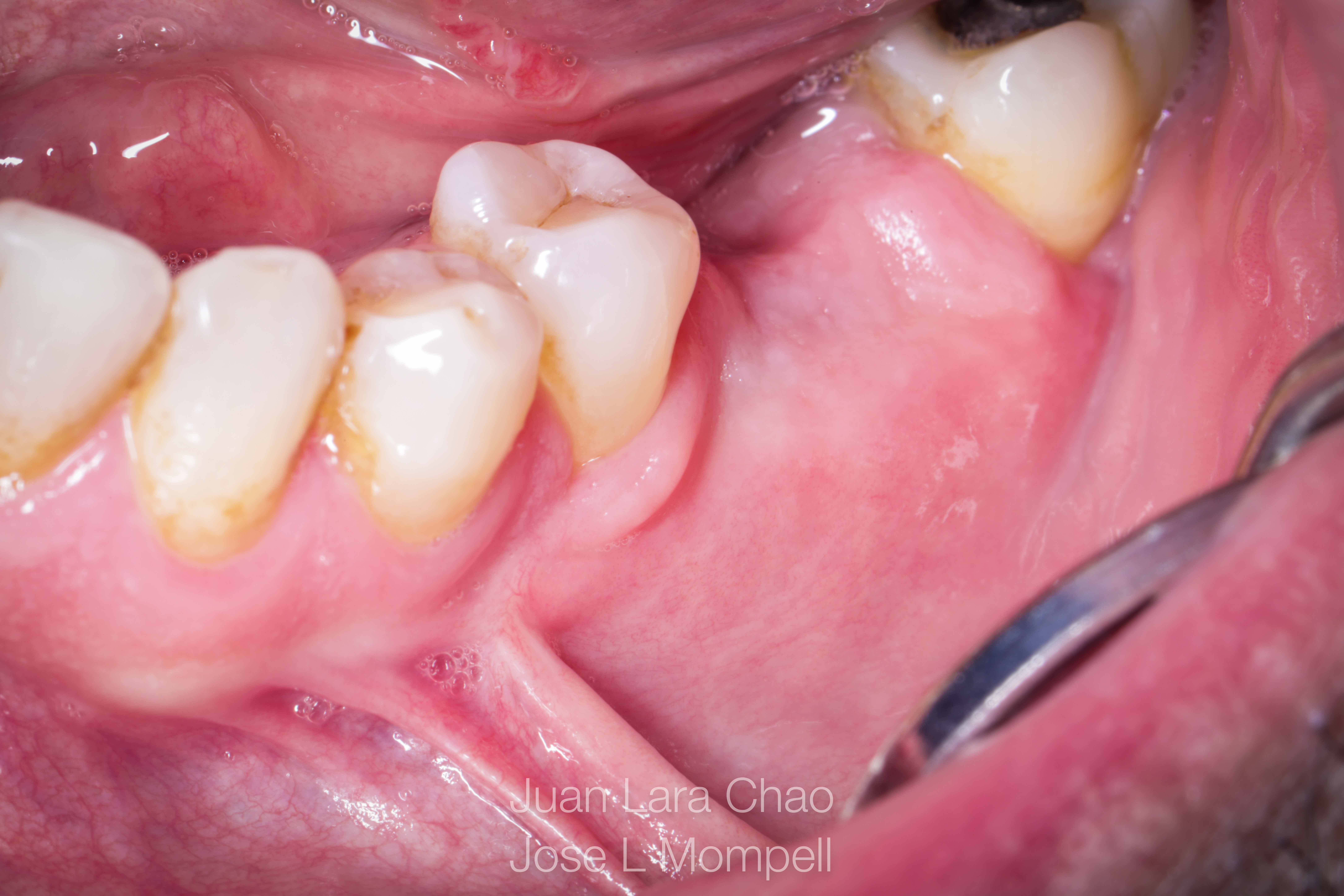 how to remove a fractured implant