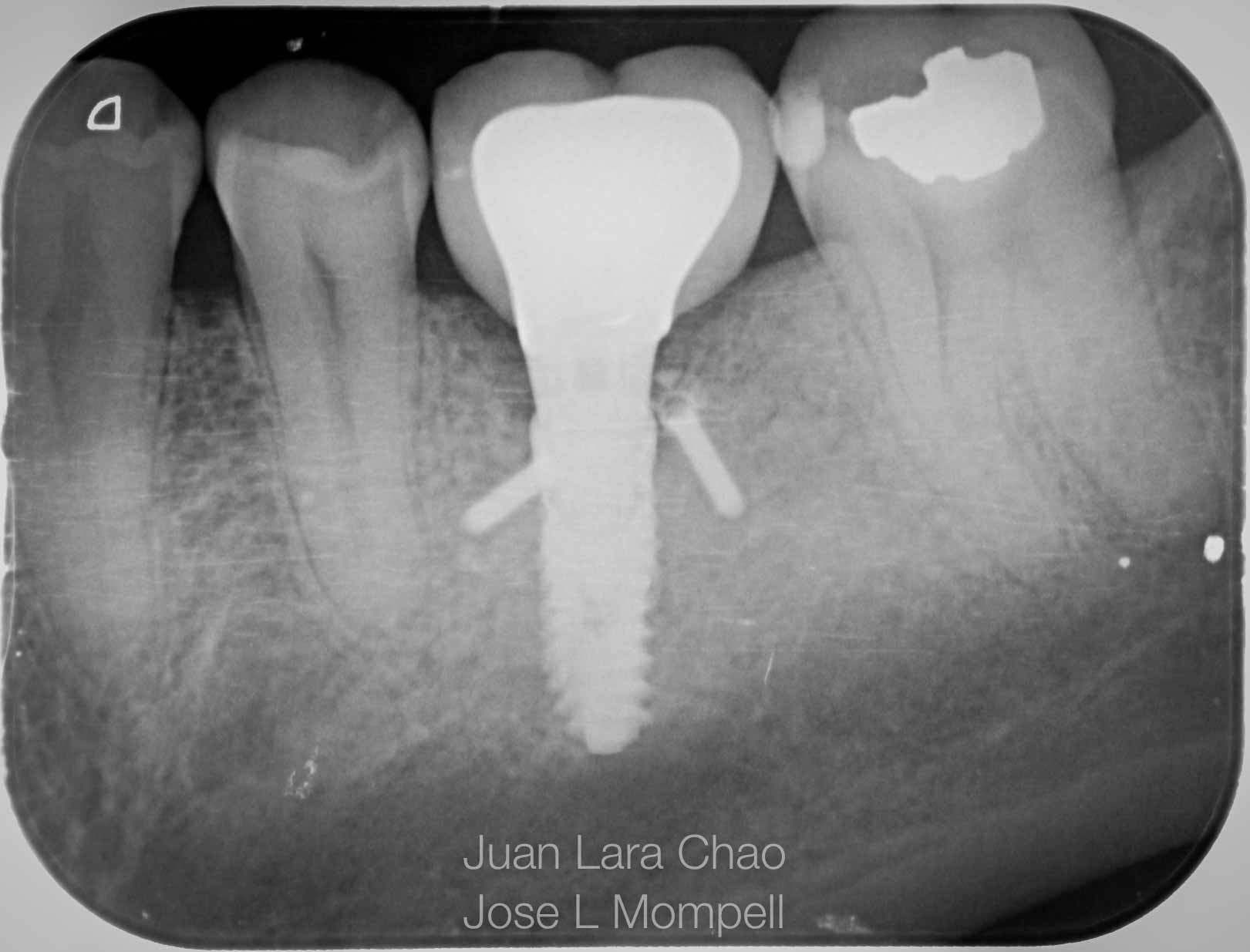 how to remove a fractured implant