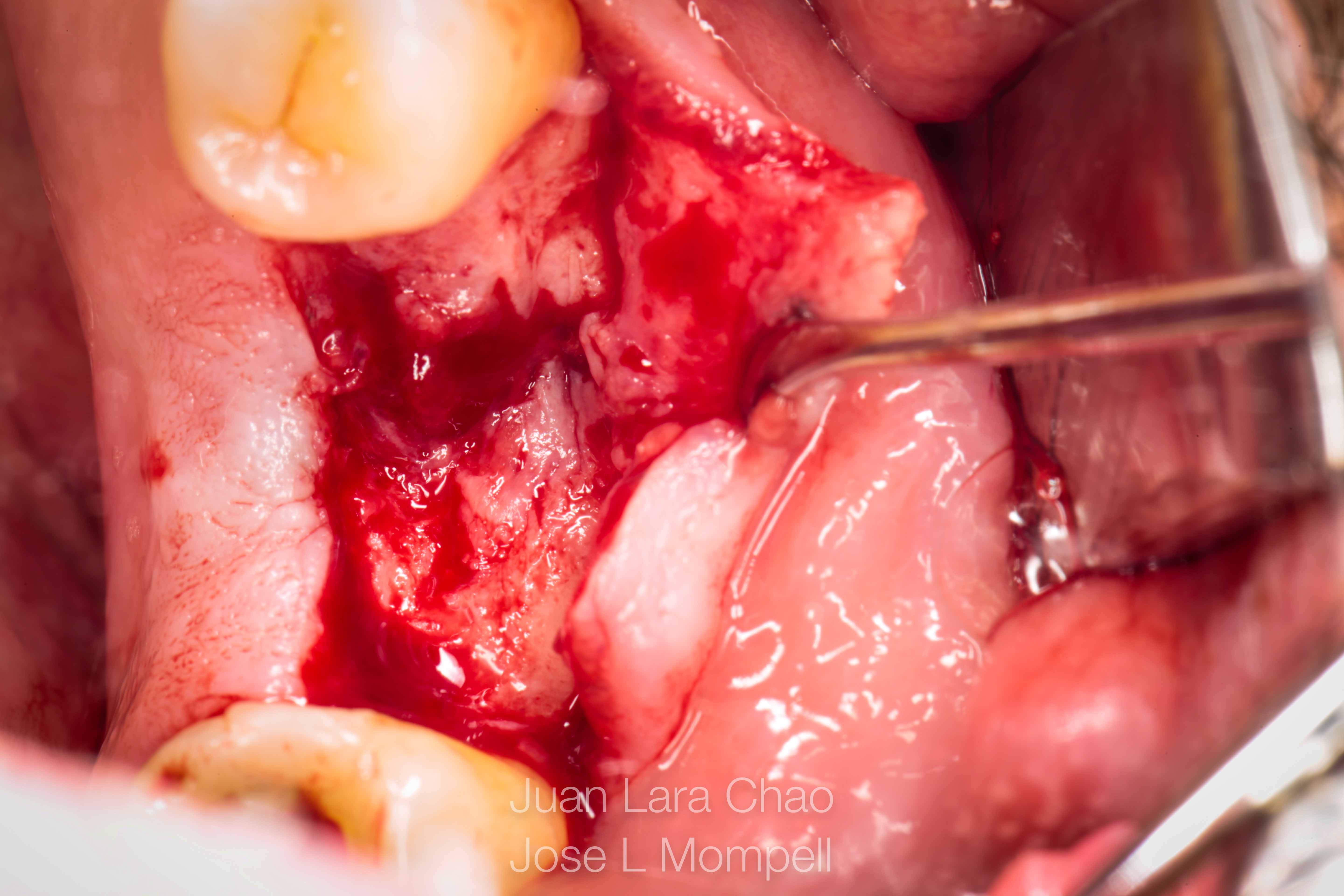 how to remove a fractured implant