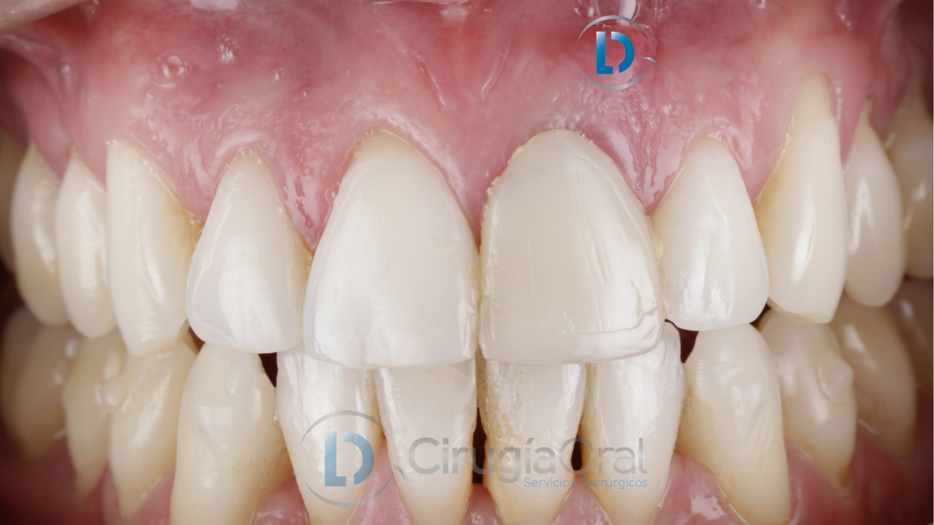 Dental implant in the aesthetic zone