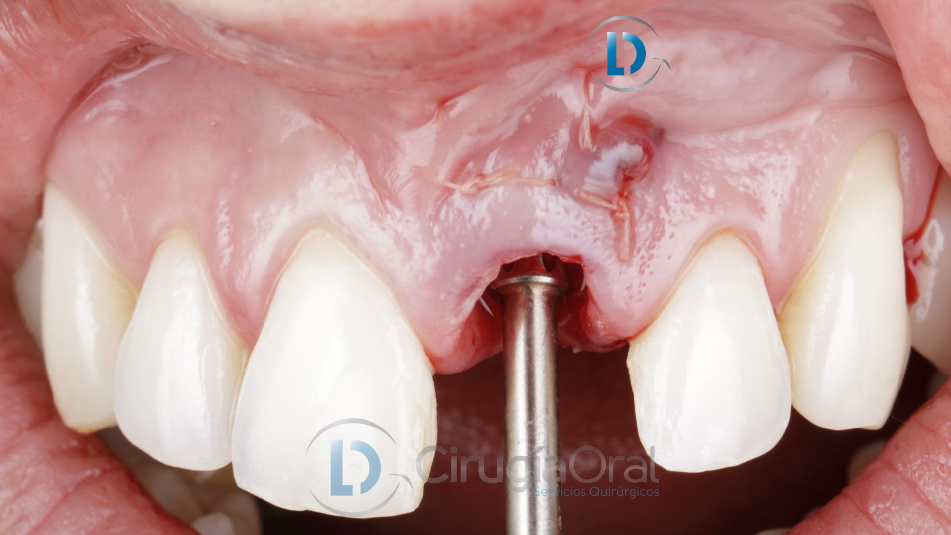 Dental implant in the aesthetic zone: Bone graft + Soft tissue + Immediate loading