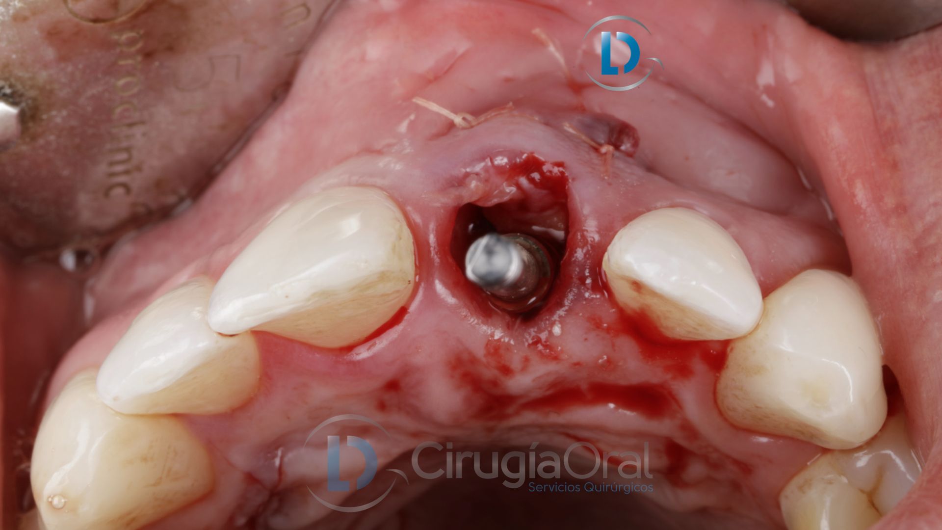 Dental implant in the aesthetic zone