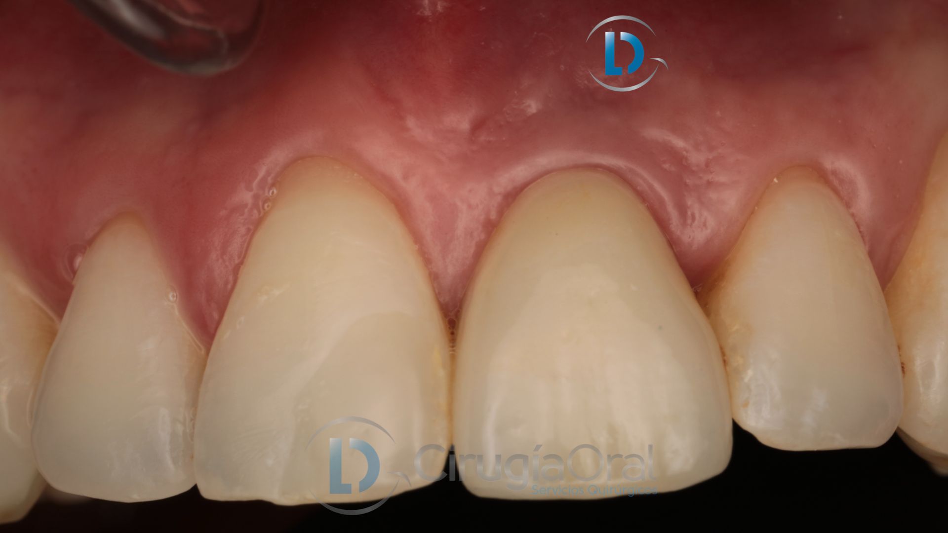 Dental implant in the aesthetic zone