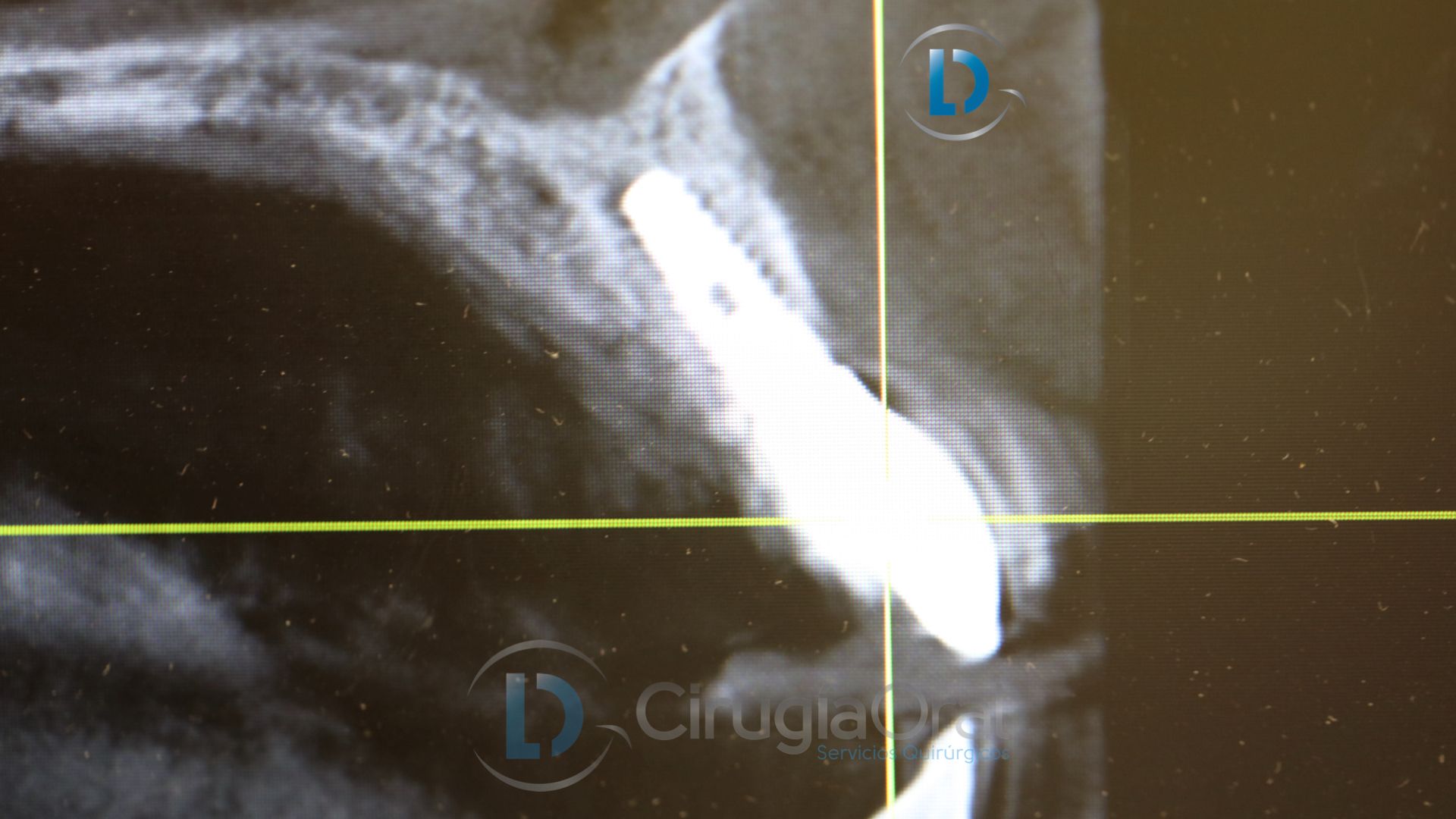 Dental implant in the aesthetic zone