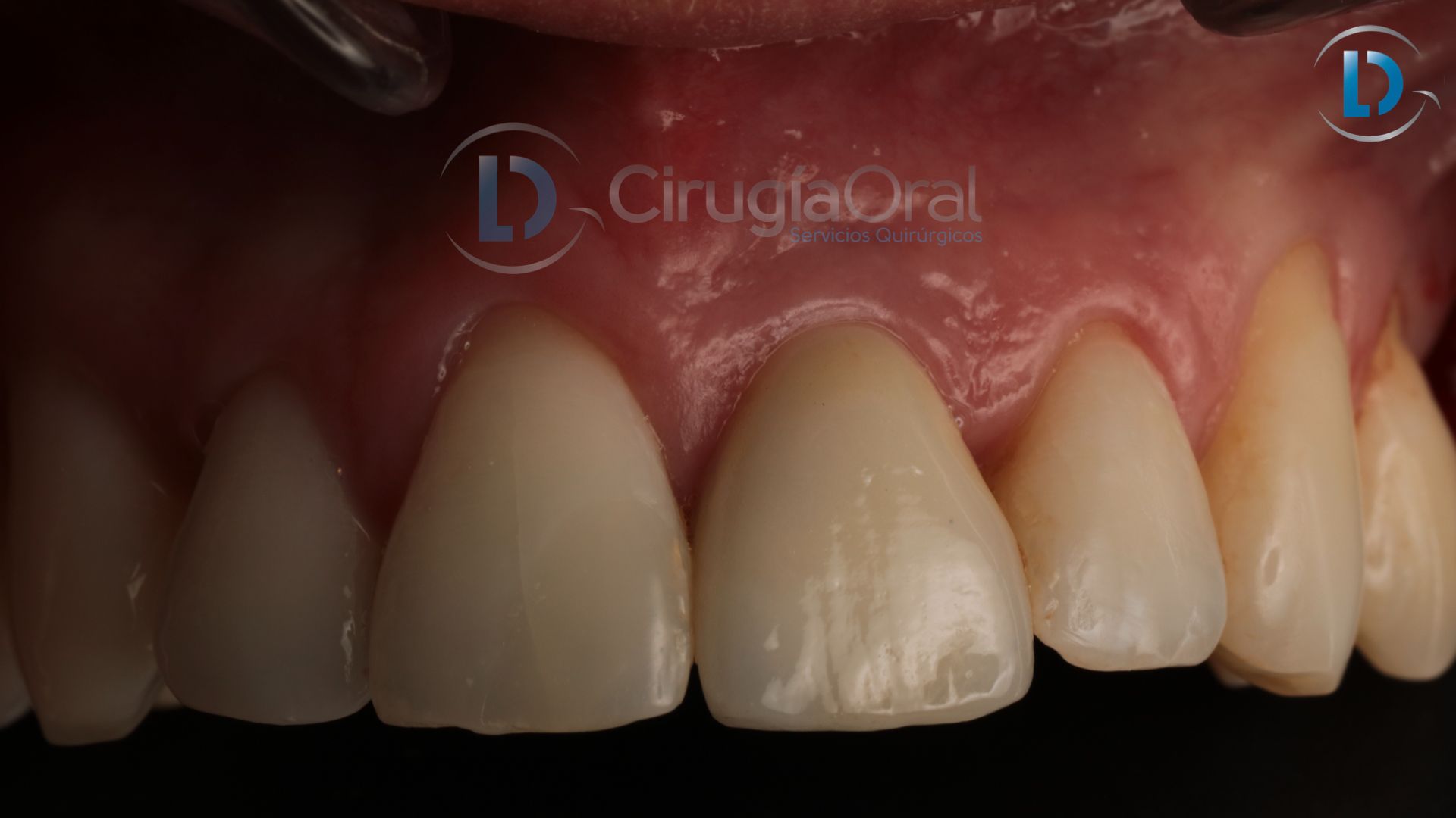 Dental implant in the aesthetic zone