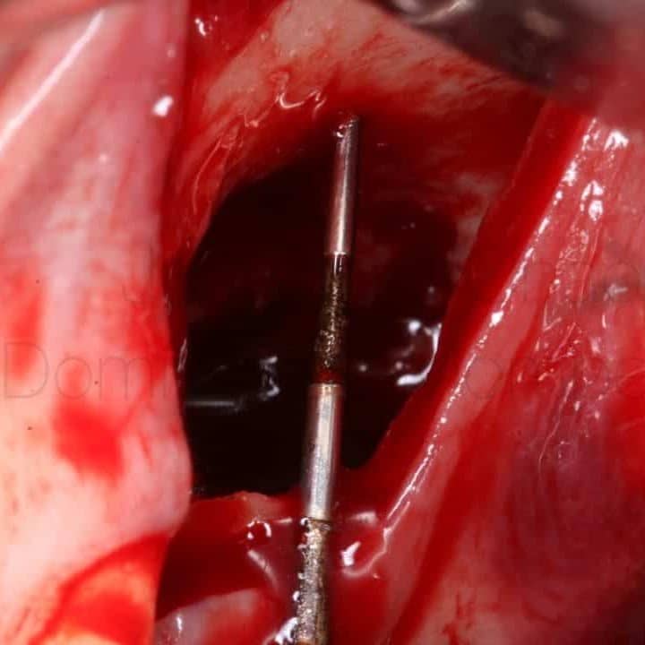 Surgical bone access procedure for dental implantology