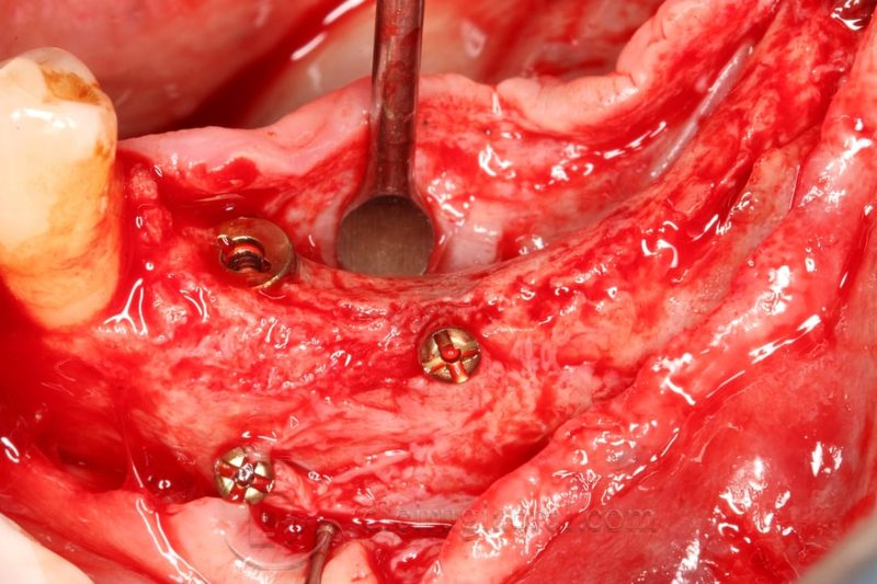 Implant placement in augmented area