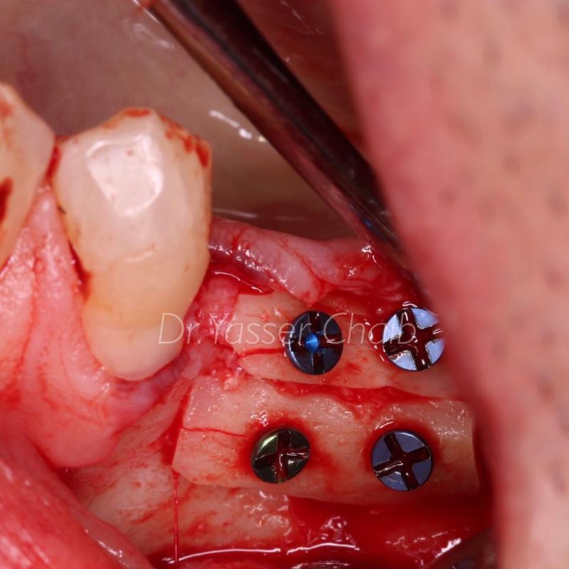 Posterior Mandible Reconstruction with Tunnel Approach