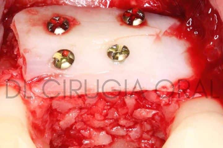 Khoury Technique Course: Step-by-Step Bone Reconstruction